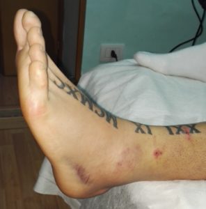 La distorsione della caviglia e del piede rappresenta il trauma sportivo più diffuso (circa il 25% di tutti gli infortuni da sport) e colpisce soprattutto coloro che praticano attività di salto. Le discipline più a rischio sono: pallacanestro, calcio, pallavolo, atletica leggera, ginnastica. La fase di “atterraggio” dopo lo stacco verso l’alto è il momento di massimo rischio (soprattutto negli sport dove c’è contatto con l’avversario). Inoltre, gli arresti improvvisi su terreni veloci (come i campi sintetici del calcetto) e l’appoggio a terra “sconnesso” (nelle corse campestri) rappresentano situazioni a forte rischio. Esistono poi dei fattori predisponenti: ci sono sportivi che più facilmente vanno incontro a questo tipo di trauma a causa di disfunzioni della ripartizione dell’appoggio podalico a terra ( piede piatto, piede cavo, ecc.) o anche “recidive” di distorsioni non curate correttamente. La distorsione della caviglia è la lesione più frequente nella pratica sportiva, ed interessa maggiormente il legamento laterale esterno ed eccezionalmente il legamento laterale interno. Un mancato riconoscimento della lacerazione legamentosa e un incongruo trattamento espone l’atleta alla instabilità cronica della caviglia, rischio molto grave per il futuro dell’atleta. Sintomi Dolore, localizzato a livello della zona anteriore del malleolo peroneale, che insorge durante la palpazione; Tumefazione modesta o cospicua a livello periarticolare ed articolare, segno della rottura della piccola arteriola passante al di sopra del legamento peroneo-astragalico anteriore (segno di Robert-Jaspert); Limitazione funzionale causata dal dolore che il paziente avverte durante i movimenti dell’articolazione; Instabilità dell’ articolazione tibio-tarsica