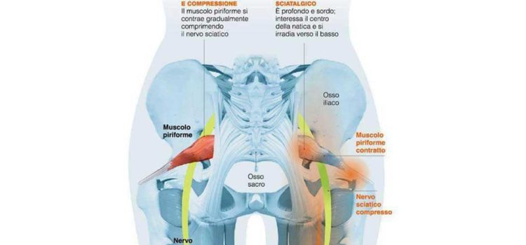 Sindrome del piriforme Sindrome del piriforme